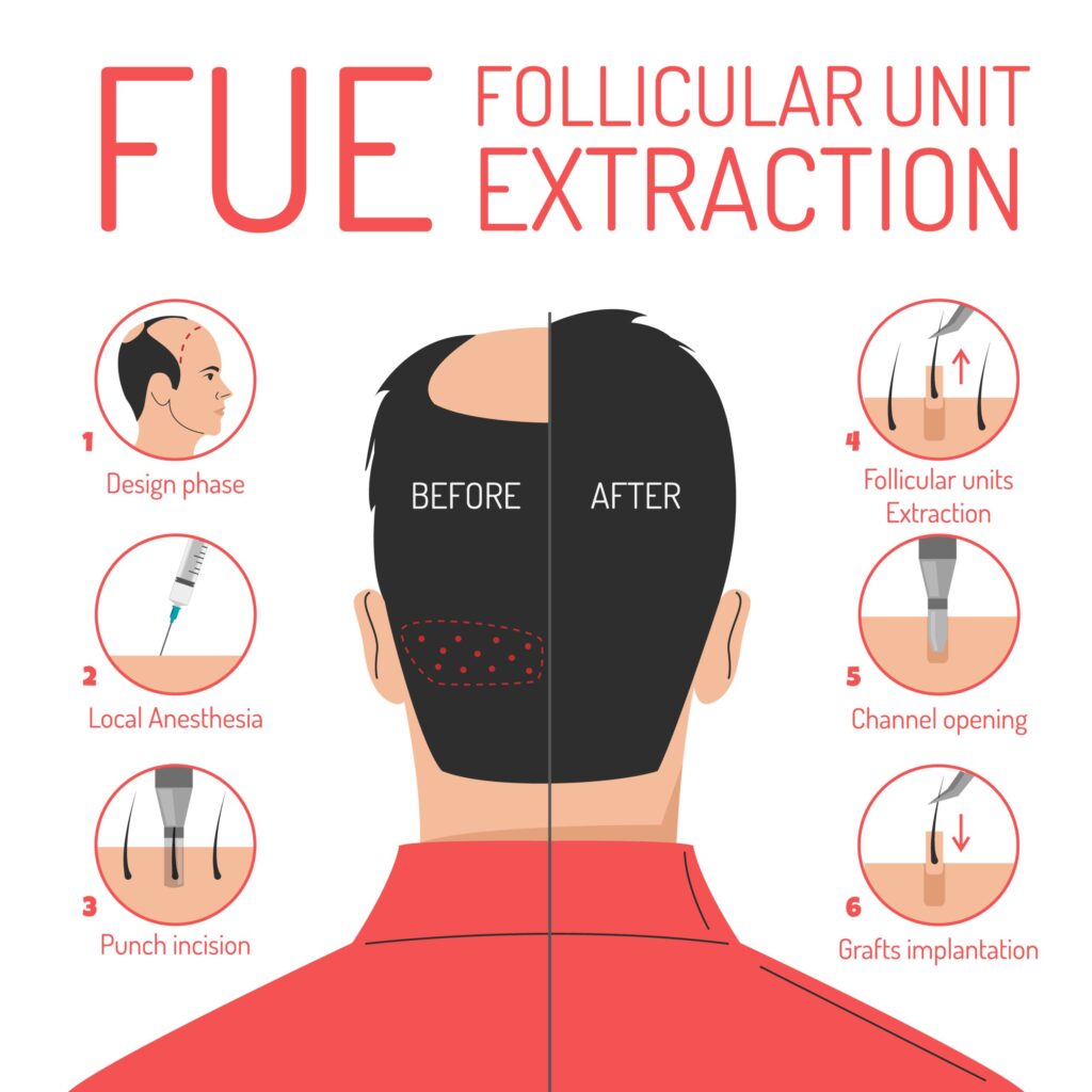 Is FUE Hair Transplant Worth It? Cost, Benefits, Procedure & Best Clinics 2025